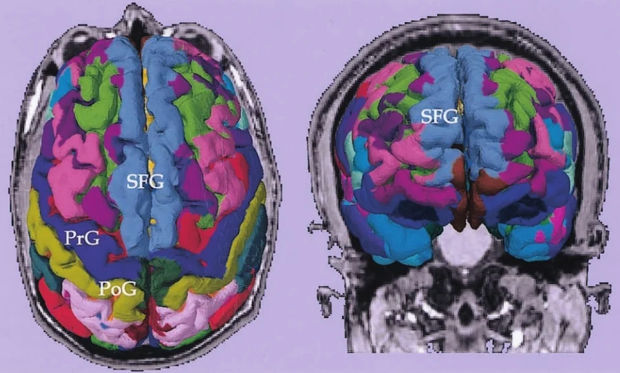 Schermata di 3D Slicer del 2004: sezione di risonanza cerebrale con parcellazione corticale a colori e sigle dei giri (PrG, PoG, SFG) di un paziente con tumore.