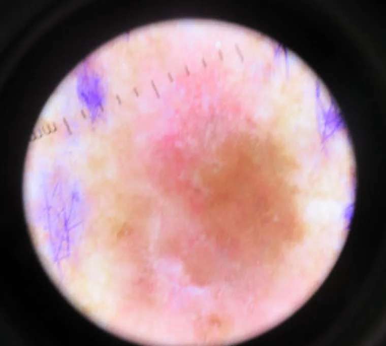 Vista al dermatoscopio di un melanoma maligno della pelle: macchia pigmentata bruno-nerastra a bordi irregolari su cute, con segni di marcatura per la biopsia.