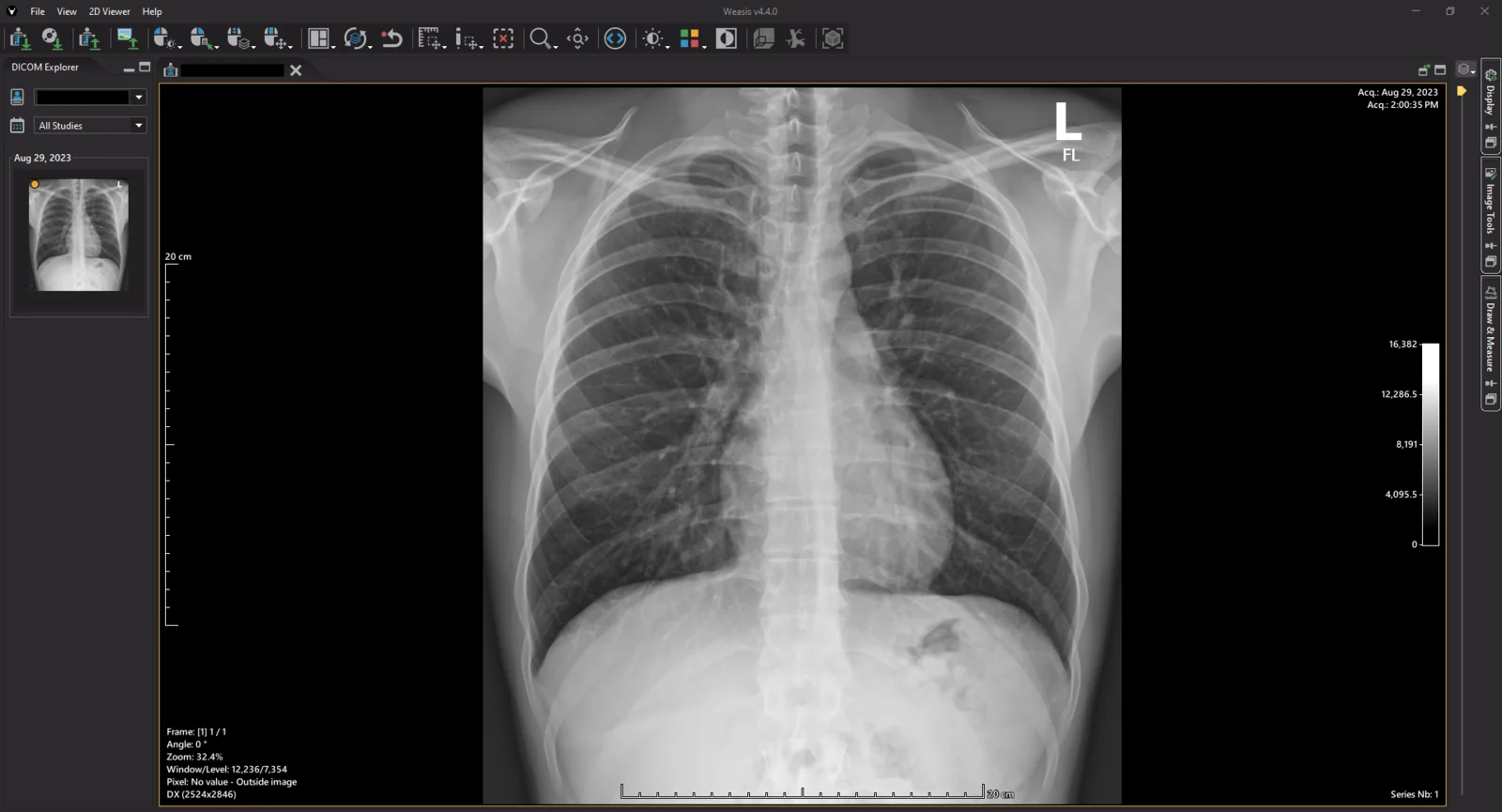 Schermata del visualizzatore DICOM open-source Weasis con una radiografia del torace e gli strumenti della workstation radiologica.
