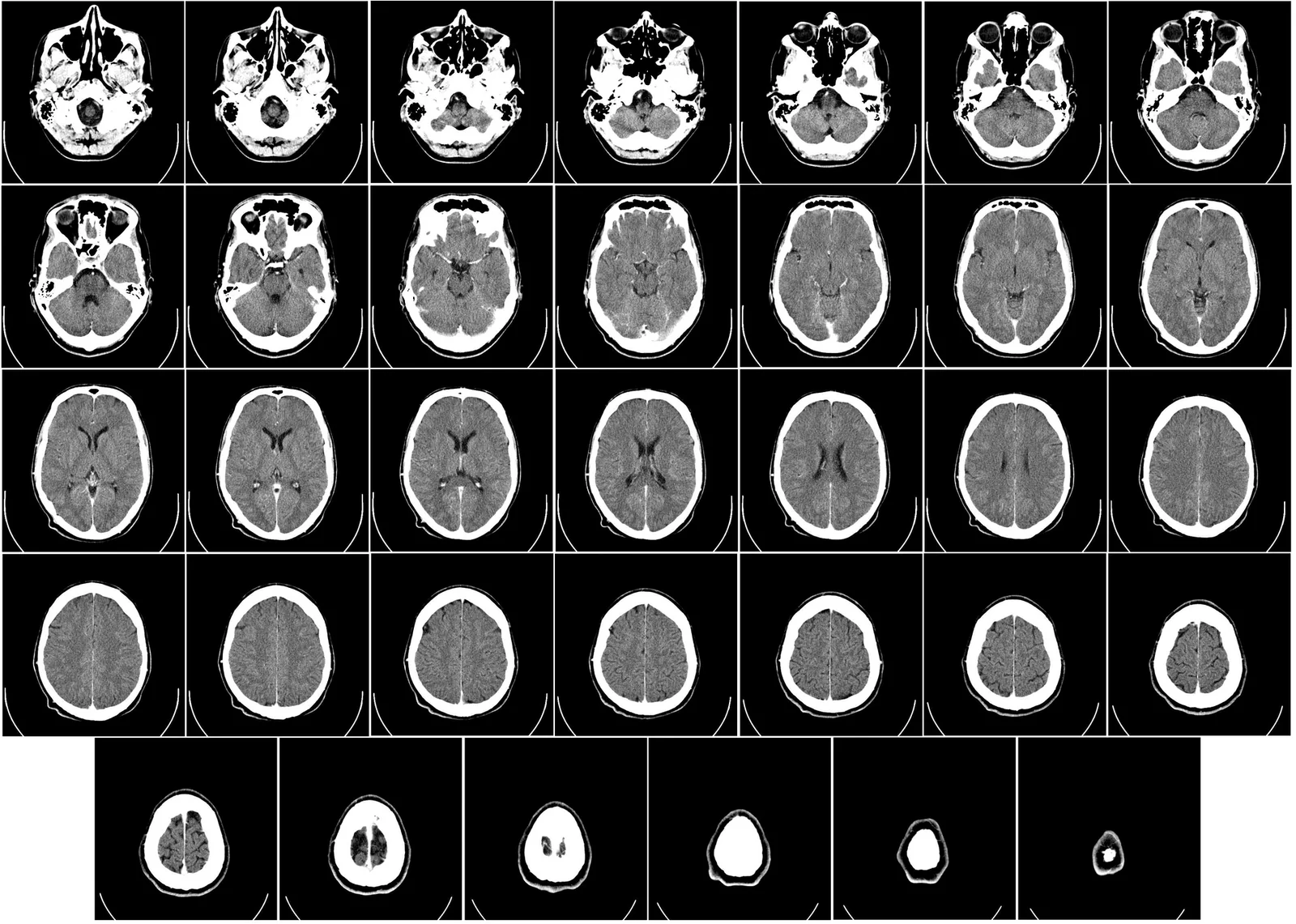 Griglia di 34 sezioni assiali in scala di grigi di una tomografia computerizzata del cervello, dalla base del cranio alla volta.
