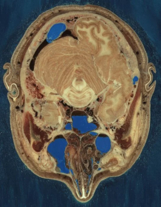 Sezione anatomica trasversale a colori della testa umana ottenuta per criosezione, con strutture interne di cervello, occhi e ossa craniche visibili.
