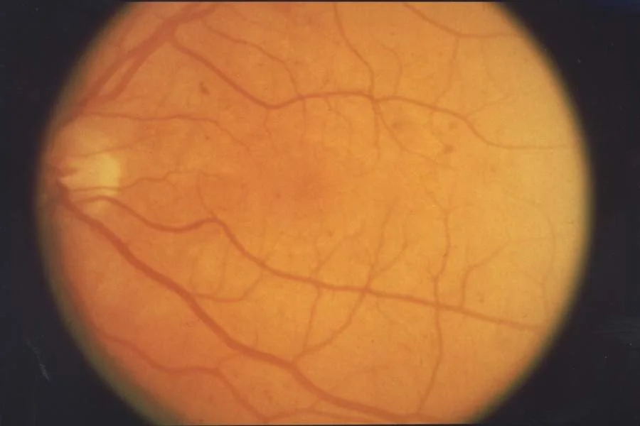 Fotografia del fondo oculare che mostra la retina con piccole emorragie sparse, segno di retinopatia diabetica iniziale.
