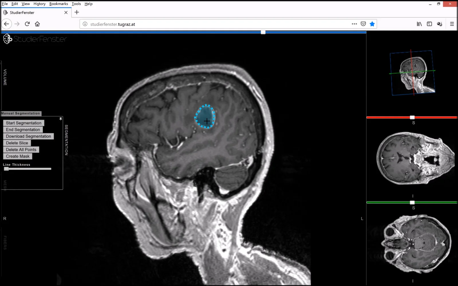 Slice assiale di una risonanza magnetica cerebrale con un tumore (glioblastoma) evidenziato da una maschera di segmentazione colorata sovrapposta.
