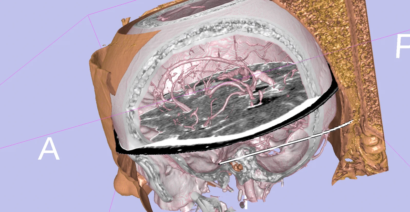 Rendering volumetrico 3D di una testa umana in 3D Slicer: cranio e vasi cerebrali resi in trasparenza, con un piano di taglio che rivela una sezione assiale interna.