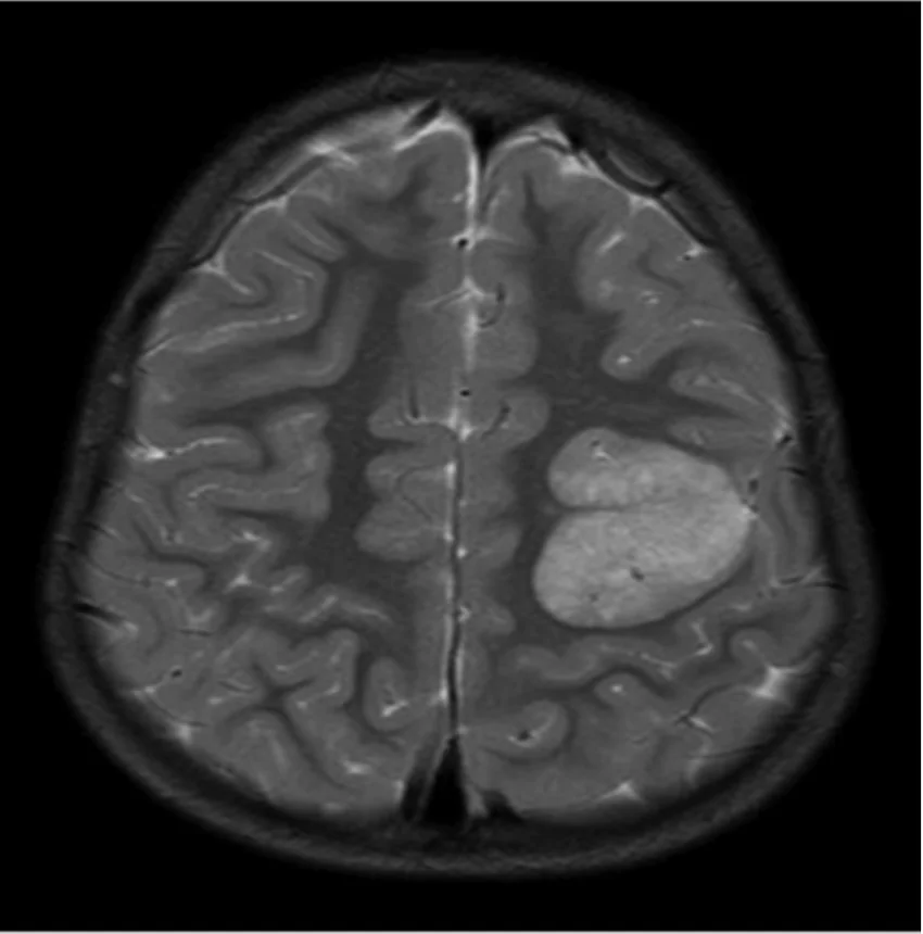 Risonanza magnetica cerebrale in sezione assiale, ponderata T2, con una lesione tumorale chiara (iperintensa) nella corteccia di un emisfero.