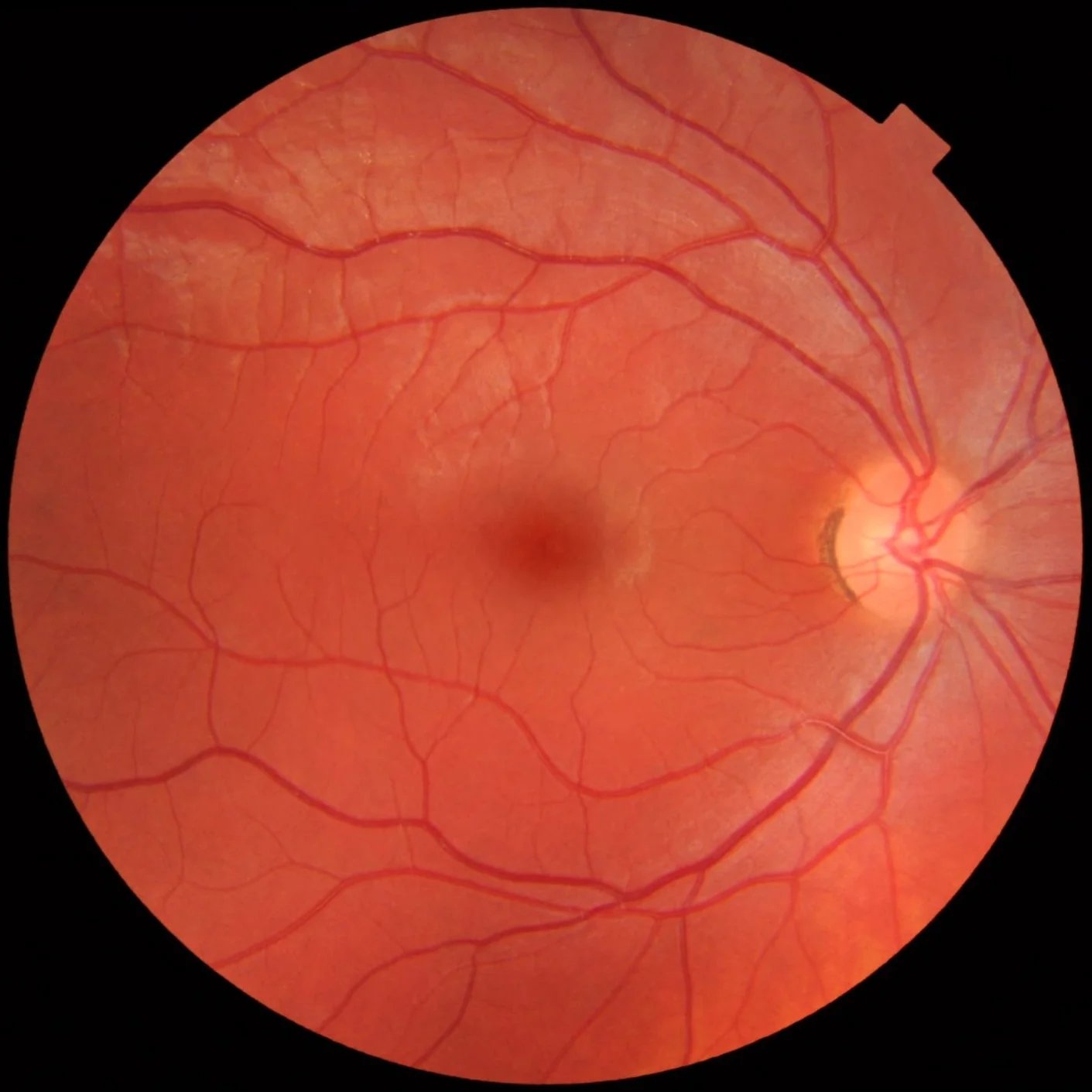 Fotografia del fondo oculare di un occhio destro sano: cerchio arancio-rossastro con il disco ottico chiaro sulla destra, la macula al centro e i vasi sanguigni retinici che si diramano.