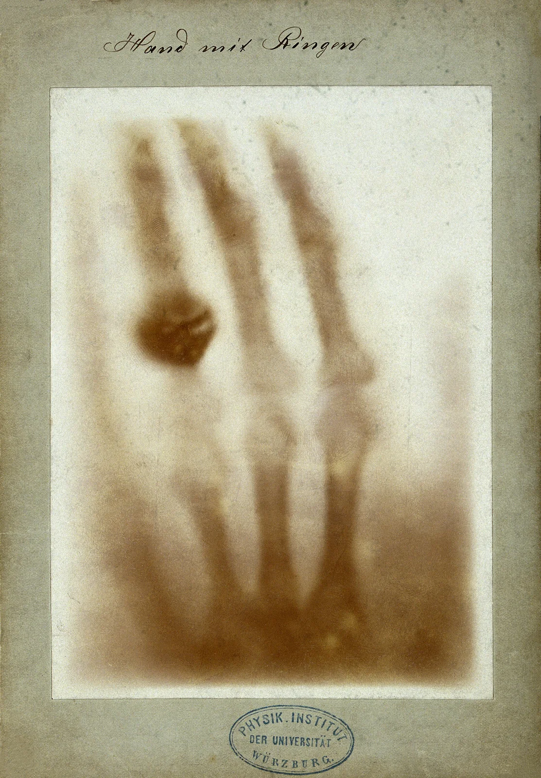 Radiografia in bianco e nero di una mano umana con un anello al dito anulare; le ossa appaiono chiare su sfondo scuro.
