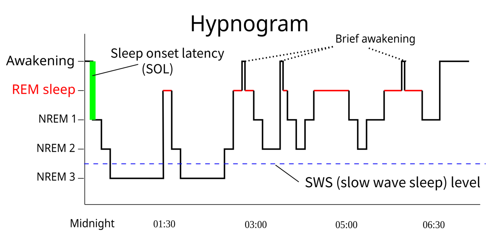 Ipnogramma: grafico degli stadi del sonno (veglia, REM, N1, N2, N3) tracciati epoca per epoca nel corso di una notte, con i cicli di sonno e le transizioni fra le fasi.